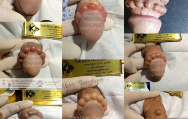 Các Loại Viên Bi Trên Thị Trường Dùng Trong Cấy Bi Cho Nam Giới