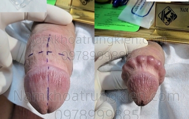 Tìm Kiếm Trung Tâm Cắt Bao Quy Đầu Uy Tín Tại Hồ Chí Minh