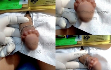 Xu Hướng Cấy Bi Dương Vật Cho Nam Giới Hiện Nay