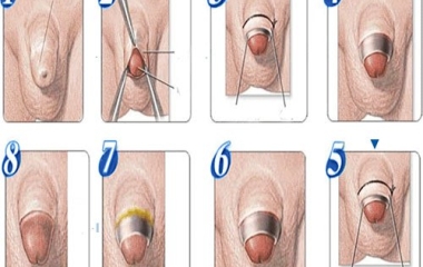 Quy Trình Cắt Bao Quy Đầu An Toàn, Thẩm Mỹ Tại Nam Khoa Trung Kiên