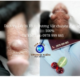 Cấy bi bộ 3 đá Cao Cấp