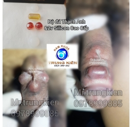 Cấy bi bộ 5 viên Bao Bự Bao Phê cho chị em