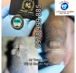 Cấy bi bộ 3 viên đá Thạch Anh thiên nhiên