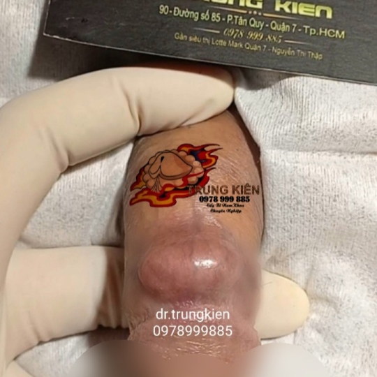 Cấy Bi Viên Ovan Êm ái Kích thích bạn Tình 