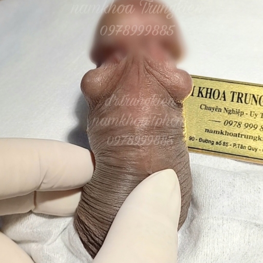 Cấy Bi Bộ Vòng Bi Bạc Đạn cho 1 viên Điểm G đặc biệt