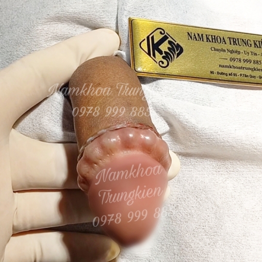 Cấy Bi giúp Đôn To cậu nhỏ hiệu quả - Cấy Bi an toàn Hcm