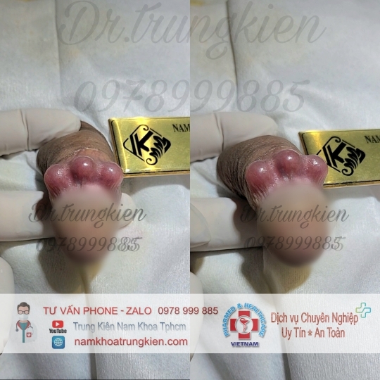 Cấy Bi Full cho Cậu Nhỏ 