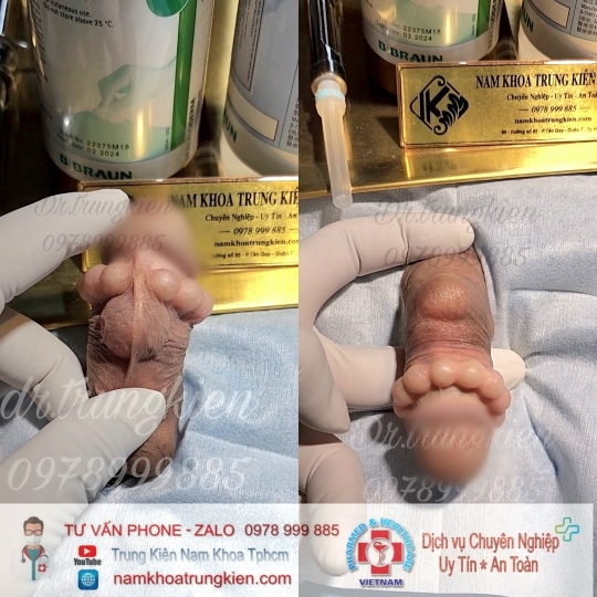 Gắn Bi bộ 3 viên điểm G mang lại cảm giác tuyệt vời 