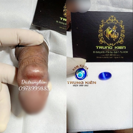 Cấy bi Chuỗi dọc thân Cậu Nhỏ 