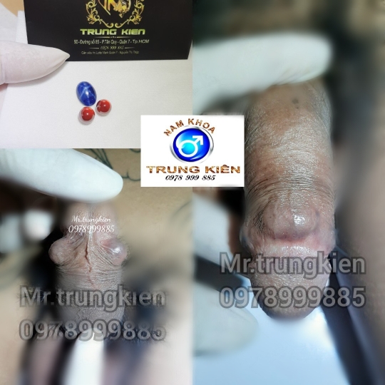 Hình ảnh cắt bao quy đầu an toàn 100% ko Đau