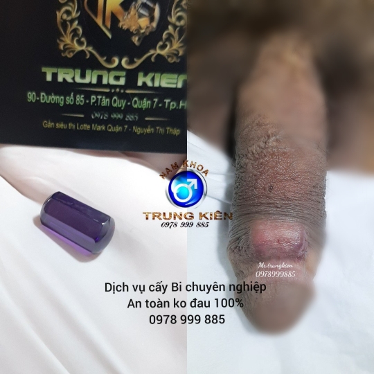 Cấy bi Chuỗi dọc thân Cậu Nhỏ 