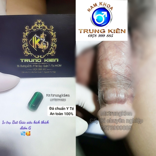 Viên Bi đá Ovan Cao Cấp .Cấy Bi Găm Bi Quận 7