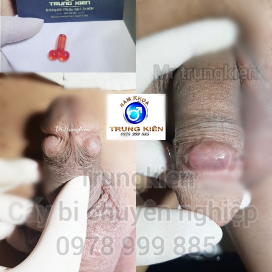 Cấy bi bộ 3 đá Cao Cấp 
