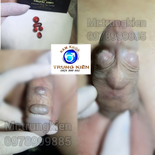 Chuỗi bi bạc đạn silicon bạch kim cao cấp