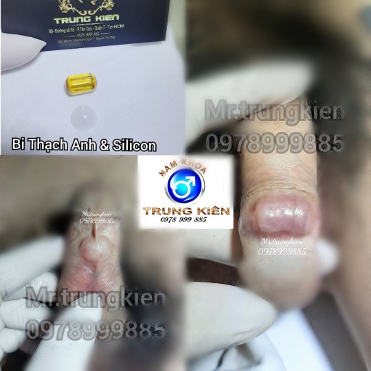 Chuỗi bi bạc đạn silicon bạch kim cao cấp