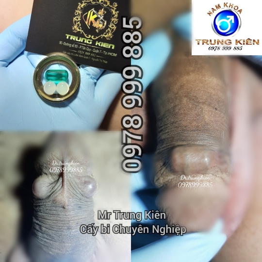 Bộ Bi 5v xoay vòng Bạc Đạn 