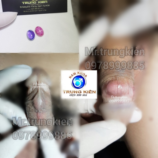 Silicon Nano cao cấp bộ 3v 